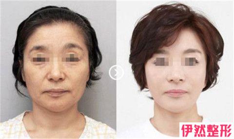 复合彩光嫩肤整形费用是多少