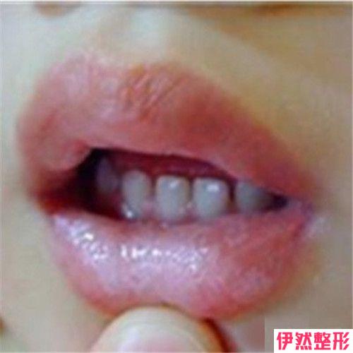 漂全唇手术价格受到什么影响