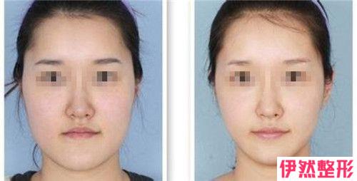 3d脸部提升的术后护理方式主要有哪些