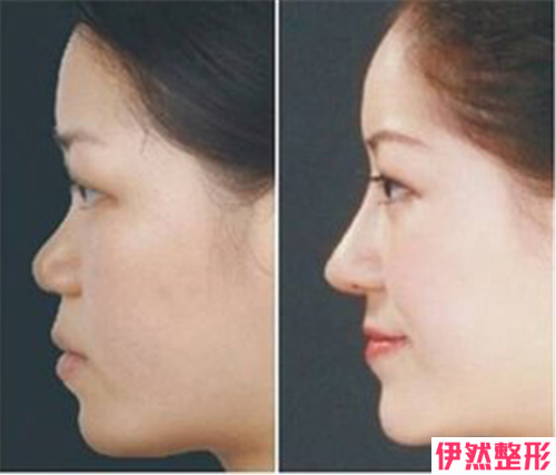 3D仿生隆鼻的果能保持多长时间