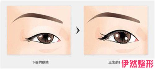 三角眼矫正的术后果怎么样，果好不好
