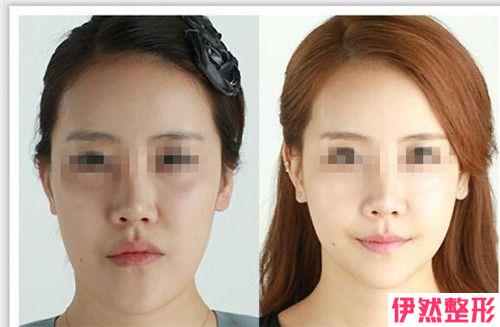去颊脂垫瘦脸假体果如何