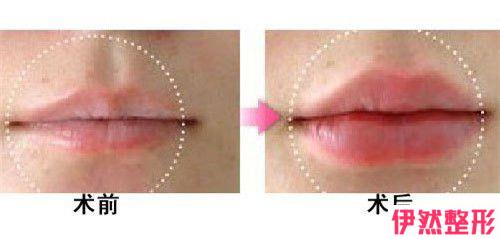 玻尿酸丰唇手术方法哪种果显著