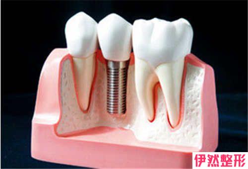 传统镶牙种植牙伤害身体吗