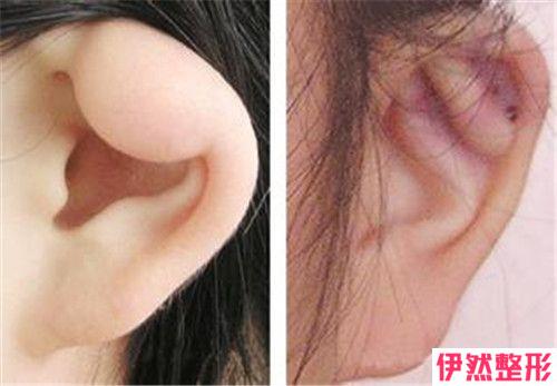 耳软骨复合隆鼻的保持时间能有多长时间