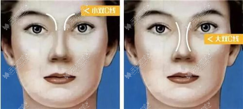 吴昌炎隆鼻设计双c线 吴昌炎隆鼻设计双c线