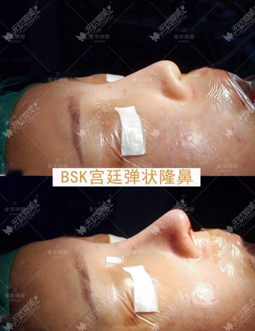 金华瑞丽全肋软骨隆鼻案例 金华瑞丽全肋软骨隆鼻案例