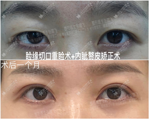 张霞飞双眼皮案例 张霞飞双眼皮案例