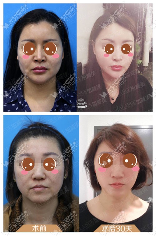 黄寅守的小切口拉皮手术案例 黄寅守的小切口拉皮手术案例