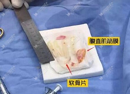 筋膜包裹软骨垫鼻尖 筋膜包裹软骨垫鼻尖