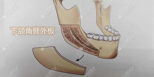 下颌骨劈外板示意图 下颌骨劈外板示意图