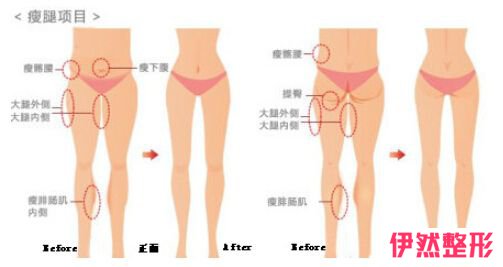 北京艺美做大腿吸脂怎么样好不好靠谱吗?