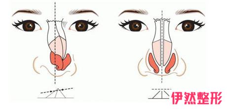 肋骨隆鼻后感觉不好,想修复咨询隆鼻失败修复