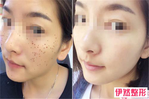 彩光祛斑需要多少钱?