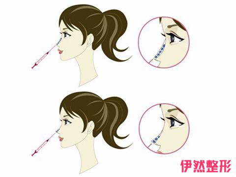 注射隆鼻术后需要注意哪些？