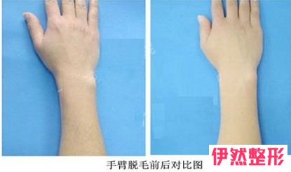 北京永久脱毛一般需要花多少钱?