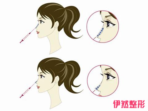 注射隆鼻有几种