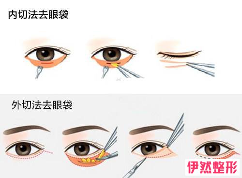 眼袋手术费用多少