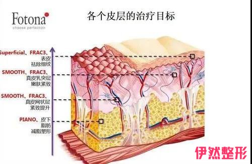 欧洲之星Fotona 4d和热玛吉有什么不同？