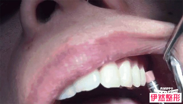 洗牙的过程是怎样的？洗牙后有哪些需要注意的？