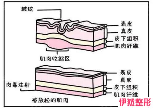 除皱针是什么?为什么除皱针会这么火?