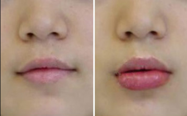 厚唇改薄恢复过程是怎样的?厚唇改薄恢复图展示