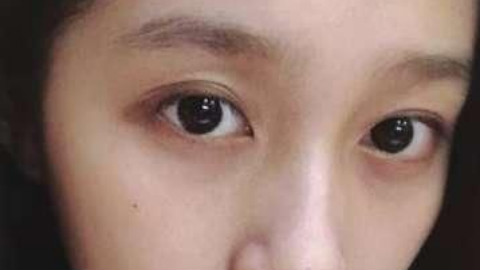 开内眼角果明X吗?开内眼角可以改良吊眼吗?