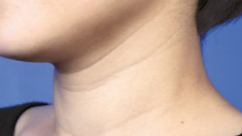 嗨体去颈纹和激光去颈纹哪个好?嗨体去颈纹好还是激光去颈纹好?