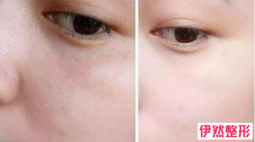 玻尿酸填充眼沟有什么副作用?玻尿酸填充眼沟有风险吗?