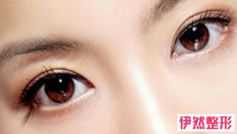 韩式三点双眼皮是不是长期的?韩式三点双眼皮大概需要多少钱?