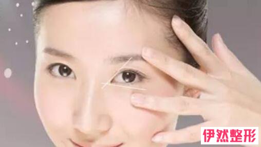 韩式微创双眼皮是全切吗?韩式微创双眼皮和全切哪个好?