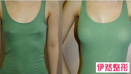 韩式隆胸美容整形手术果怎么样?韩式隆胸调节费用一般多少钱?
