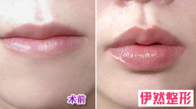 上海注射胶原蛋白丰唇哪家好?上海注射胶原蛋白丰唇多少钱?