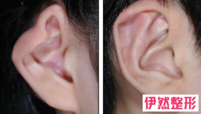 卷曲耳廓畸形是什么样卷曲耳矫正手术大概多少钱