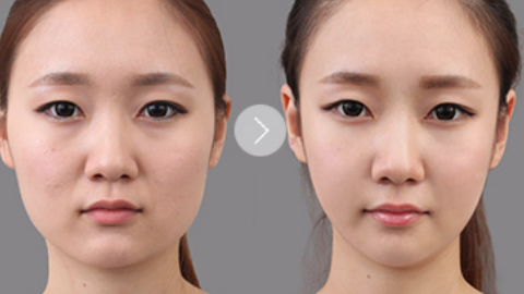 光纤溶脂瘦脸多久可以做第二次?光纤溶脂瘦脸恢复图展示?