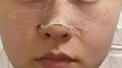 鼻部手术有后遗症吗?鼻部手术有什么后遗症?有哪些后遗症?