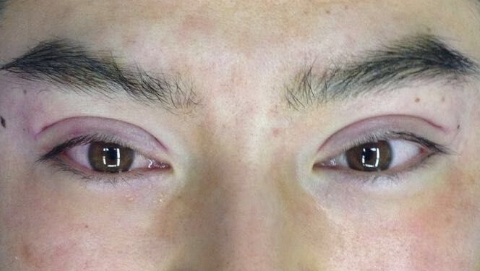 全切双眼皮会变窄吗?全切双眼皮会越来越窄吗?