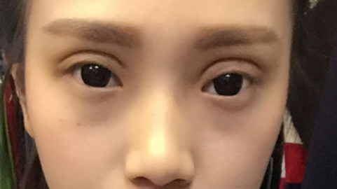 压线双眼皮几天能恢复?压线双眼皮多久恢复自然?