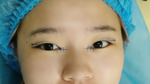 全切双眼皮有什么后遗症吗?全切双眼皮会越恢复越窄吗?
