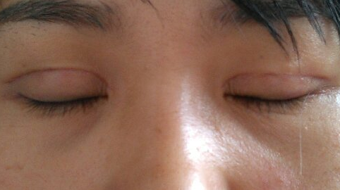 压线双眼皮多久恢复正常?压线双眼皮能保持几年?