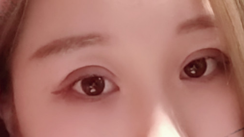 压线双眼皮和埋线哪个好?压线双眼皮和埋线双眼皮一样吗?