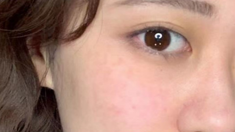 压线双眼皮和埋线哪个好?压线双眼皮和埋线双眼皮一样吗?