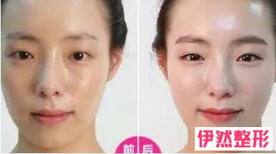 广州紫馨美容医院正规吗?隆鼻怎么样?附自体耳软骨隆鼻案例