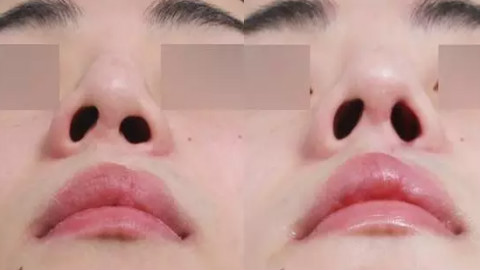 重庆当代王旭明医生做鼻子怎么样?鼻修复案例,鼻子不歪了!