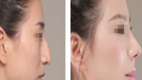 深圳星颜李信锋做鼻子怎么样?肋骨鼻部手术案例及价格表