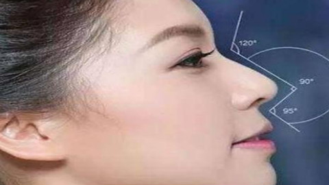 宁波鄞州薇琳刘波鼻子做得怎么样?超美耳软骨隆鼻案例分享