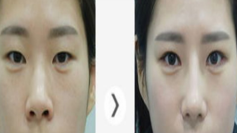 广州美莱罗延平做鼻子怎么样?半肋鼻部手术案例,精致洋气!