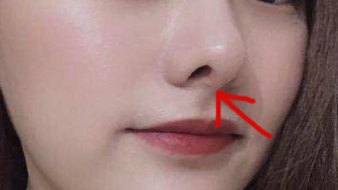 北京薇琳于海峰做鼻子怎么样?综合隆鼻术案例,手法真的很细腻!