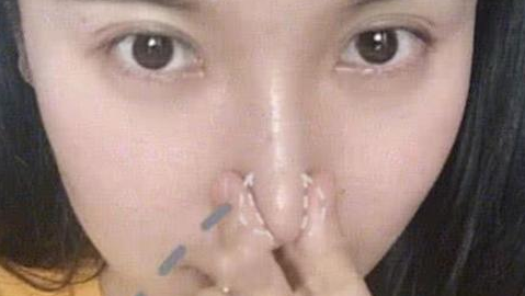 北京薇琳于海峰做鼻子怎么样?综合隆鼻术案例,手法真的很细腻!