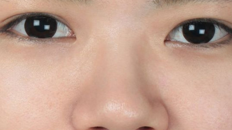 双眼皮手术修复需要多少时间?双眼皮手术修复要注意什么?